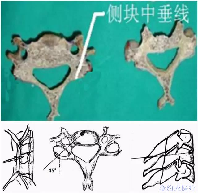 下颈椎椎弓根置钉方法的研究