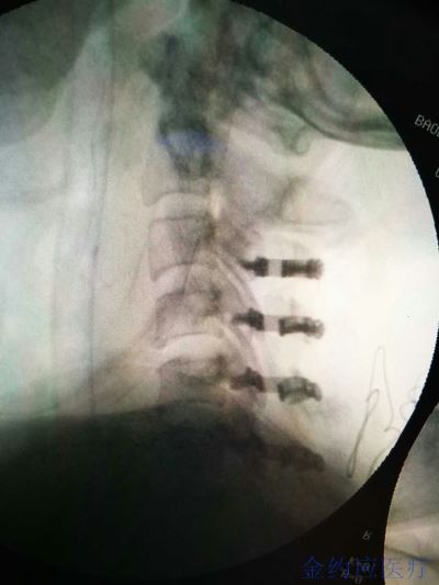 病例分享——颈椎后路椎板成型系统治疗C3-C6椎管狭窄