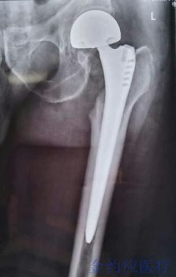 病例分享——非骨水泥加长柄假体治疗老年性股骨粗隆间骨折