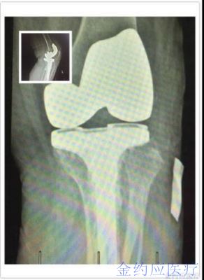 病例分享——JCCK假体治疗膝关节胫骨平台严重骨缺损患者