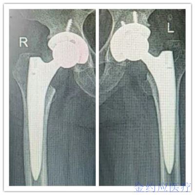 病例分享——微创柄治疗双侧股骨头坏死